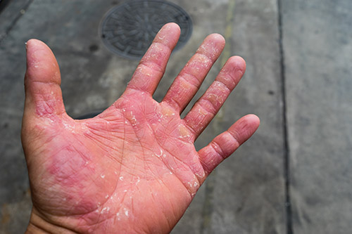latex gloves eczema